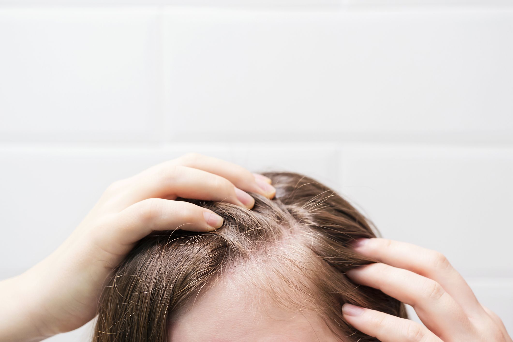 Hay muchos diagnósticos y patologías que pueden provocar alopecia | iStock